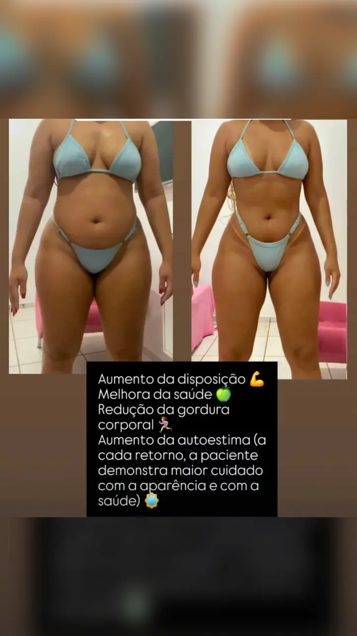 Antes e depois de paciente, vista frontal
